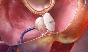 Patent Foramen Ovale Closure Devices Market Segmented by Technology, Component, Industry 2022-2028 | AGA Medical, Abbott